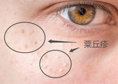 眼周长“脂肪粒”怎么办？教你分清类型对症下药