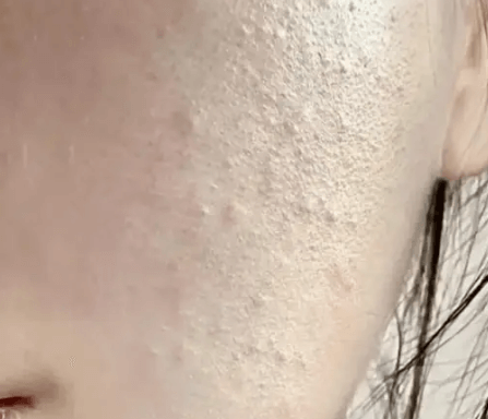 眼周长“脂肪粒”怎么办？教你分清类型对症下药插图(2)