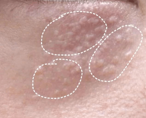 眼周长“脂肪粒”怎么办？教你分清类型对症下药插图(1)