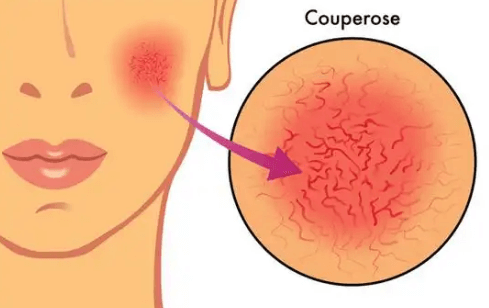 脸颊动不动就泛红、刺痛、发热？可能是玫瑰痤疮