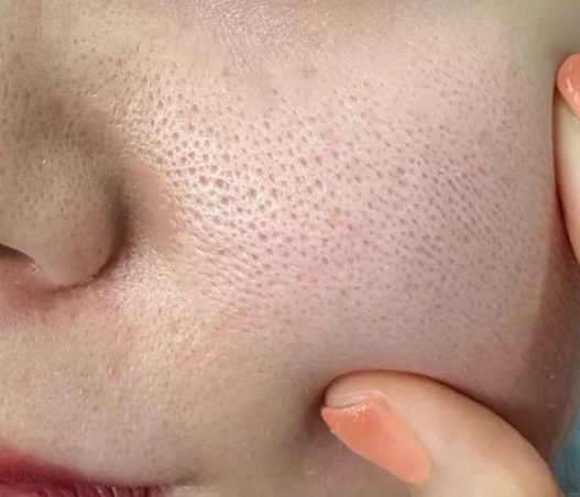 毛孔粗大真的不可逆吗?解锁“零毛孔”养肤内调法