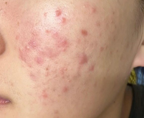 解析皮肤炎症:从泛红到衰老的隐形推手 解析皮肤炎症:从泛红到衰老的隐形推手