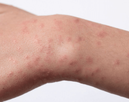 夏季皮肤“汗敏症”:汗液引发的瘙痒与红疹应对 夏季皮肤“汗敏症”:汗液引发的瘙痒与红疹应对