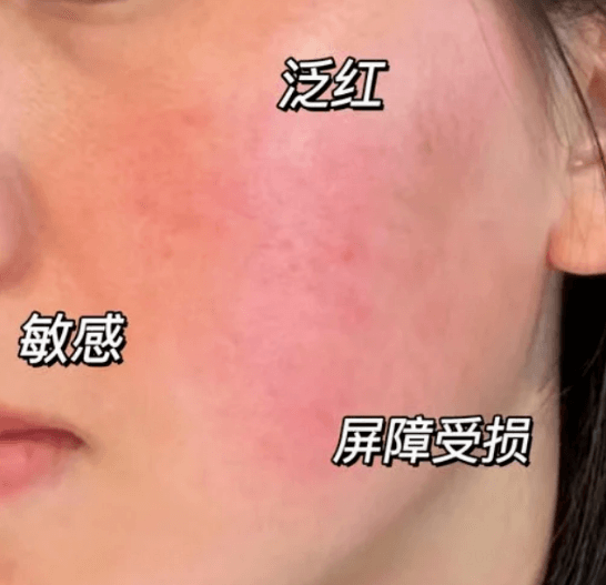 湿疹与过敏：共同的免疫系统“漏洞”