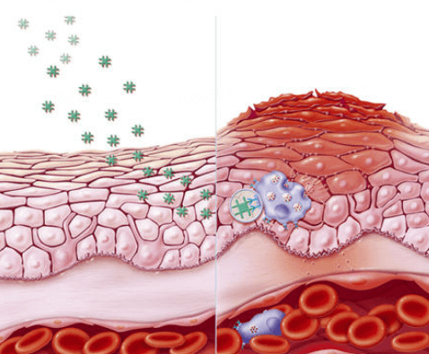 困境根源:敏感与痘痘的恶性循环 困境根源:敏感与痘痘的恶性循环