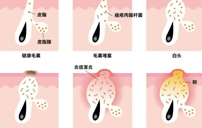 皮脂管丝 vs. 黑头:本质区别 皮脂管丝 vs. 黑头:本质区别