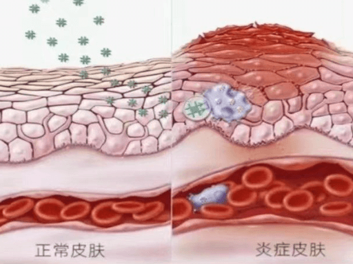 什么是皮肤微炎症?它与普通炎症有何不同?插图 什么是皮肤微炎症?它与普通炎症有何不同?插图