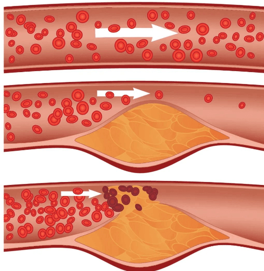 血管扩张与泛红：分析泛红为何发生且难以消退