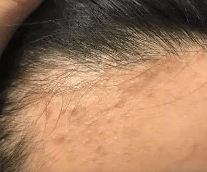 闭口痘痘反复长?看看你是哪种“代谢乱套” 闭口痘痘反复长?看看你是哪种“代谢乱套”