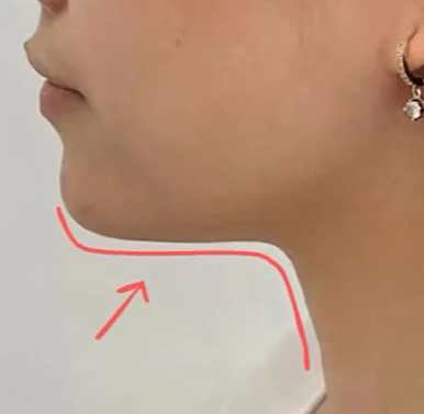 下颌线与颈阔肌：为什么你的“轮廓”会渐渐模糊?
