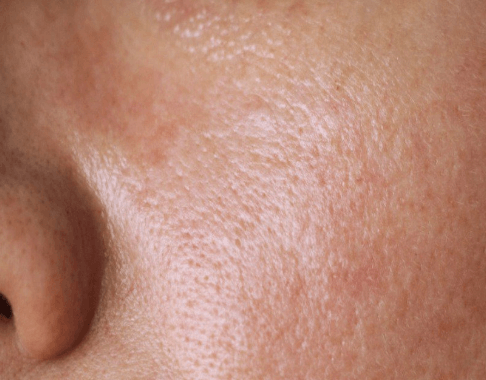 “外油内干”真相 重塑肌肤“微生态”