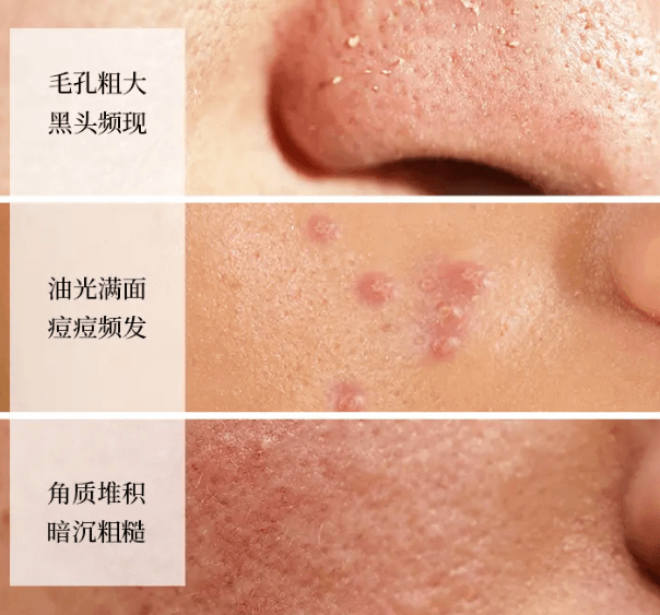 刷酸-从入门到精通，看完这篇再也不怕“烂脸”插图