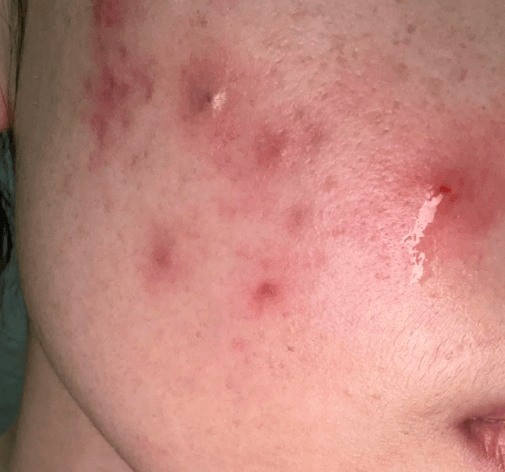 告别反复长痘,3 步科学控油消炎 告别反复长痘,3 步科学控油消炎