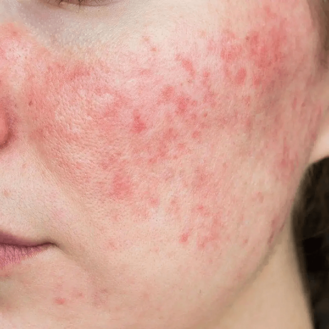 皮肤突然泛红瘙痒?过敏急救与修复全攻略