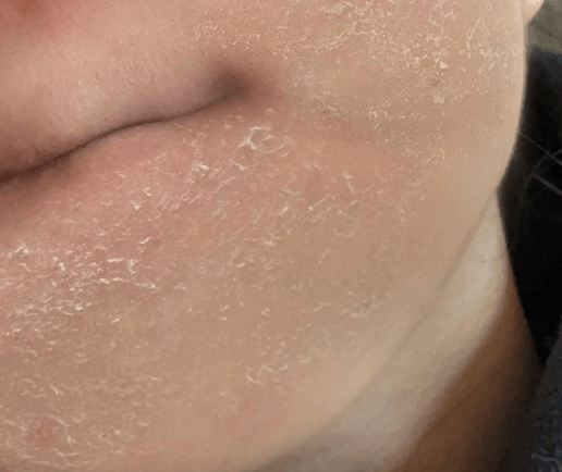 告别紧绷脱屑,3 步锁水保湿,冬天也能水嫩 告别紧绷脱屑,3 步锁水保湿,冬天也能水嫩