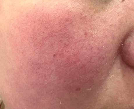 晒伤红痛别乱抹!3步急救+5天修复，让泛红快速退散插图