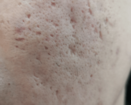 痘痘、痘印反复缠人?打破循环的5个关键方法插图 痘痘、痘印反复缠人?打破循环的5个关键方法插图