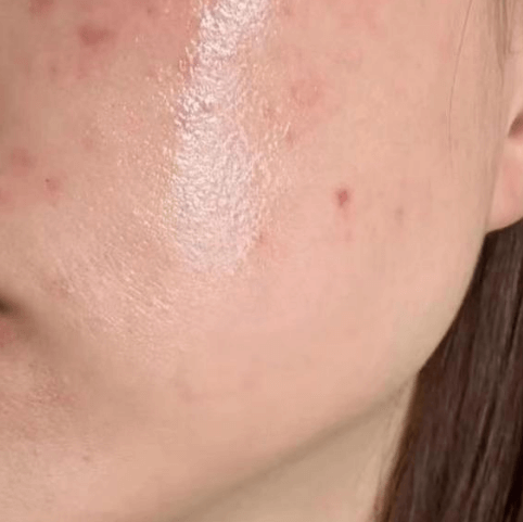 科学祛痘控油，告别油光痘肌的底层逻辑插图