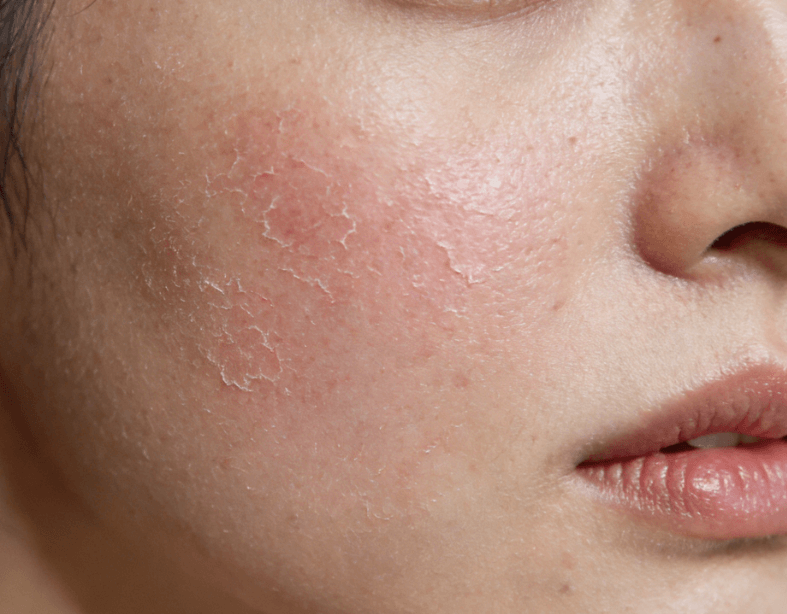 过度护肤致屏障受损：根源成因与科学修护方案