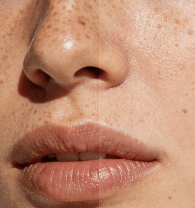 暗沉色斑别乱祛!3步科学淡斑