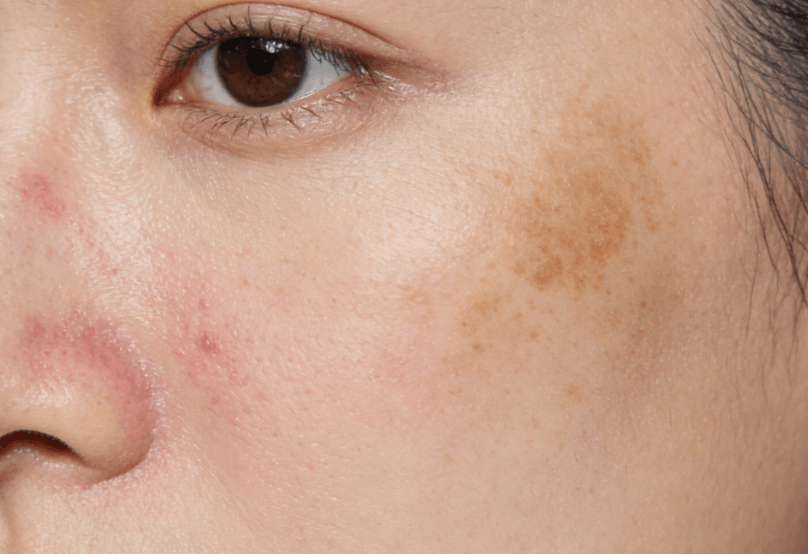 痘印色沉vs晒斑:区别、成因与差异化淡化方案 痘印色沉vs晒斑:区别、成因与差异化淡化方案