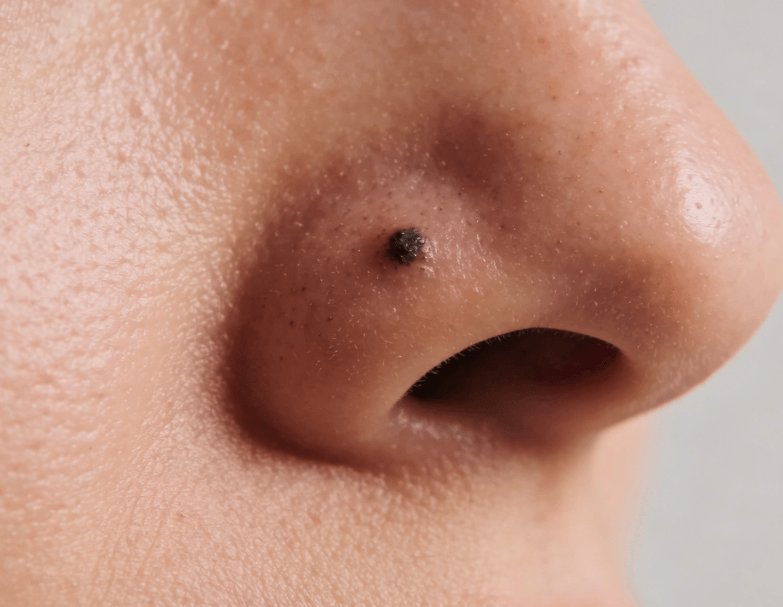 黑头的深层成因与科学改善,拒绝盲目去黑头插图 黑头的深层成因与科学改善,拒绝盲目去黑头插图