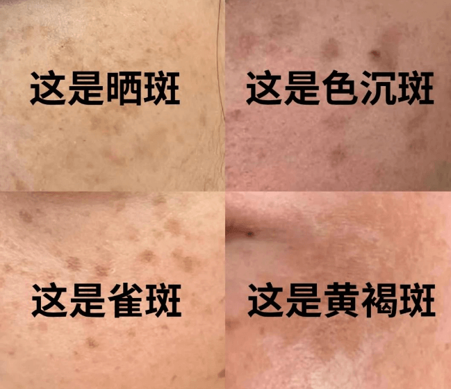 4种常见色斑，成因+特点一目了然