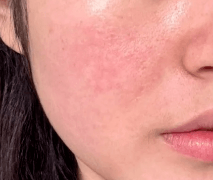 敏感肌进阶修护，摆脱反复敏感养出强韧肌肤