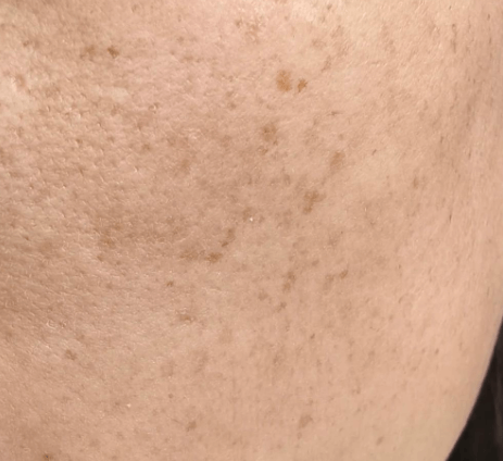 淡斑提亮进阶指南，拒绝盲目美白