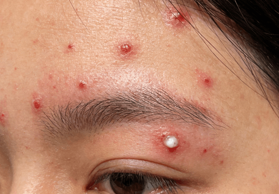 便秘→长痘、暗沉、口气：肠道排毒与肌肤的深层关联插图