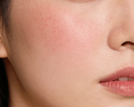 泛红刺痛应急保养指南:48小时快速稳定,避免屏障受损 泛红刺痛应急保养指南:48小时快速稳定,避免屏障受损