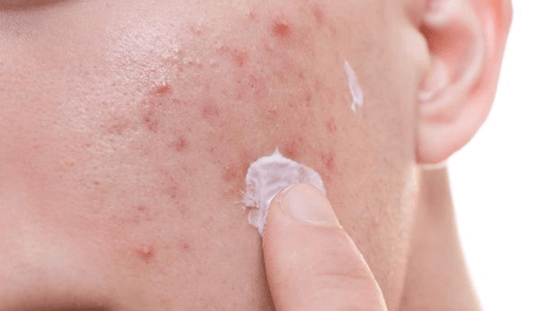 为什么你的油痘肌，越护越糟?