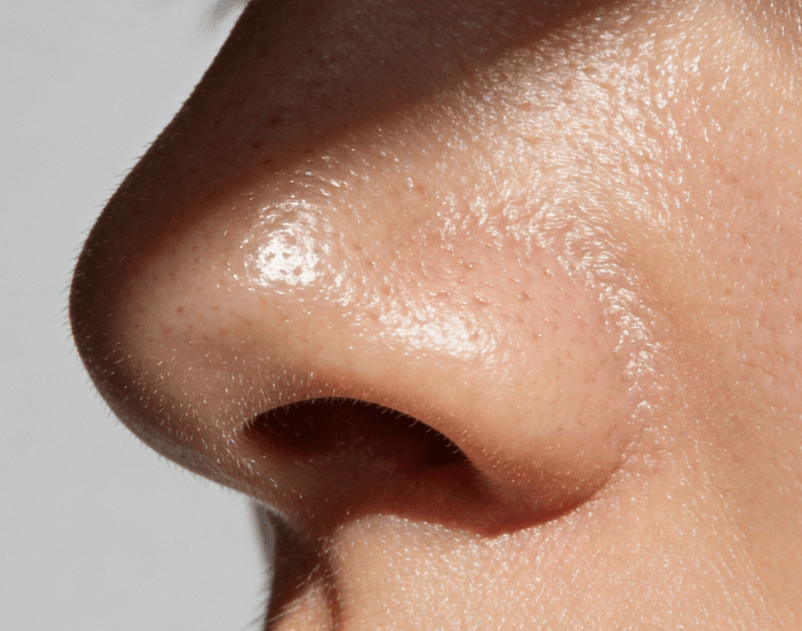 毛孔粗大+黑头反复，原来这么多年都错了插图