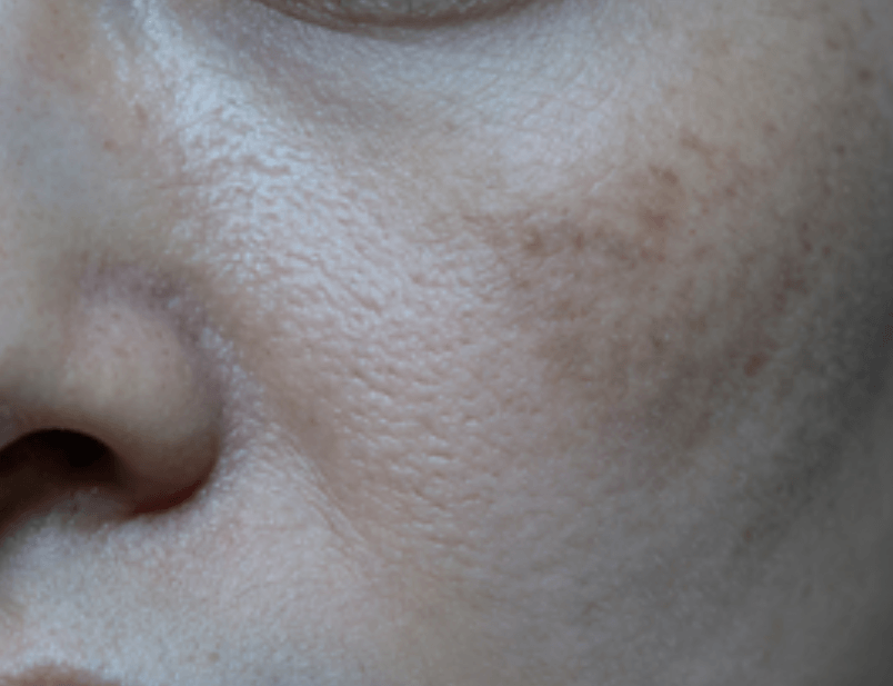 熬夜对干性肌的危害及修复方案：内调外护双管齐下