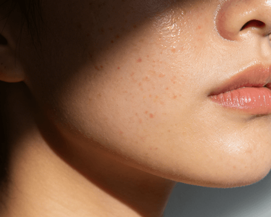 熬夜脸vs正常脸：蜡黄、浮肿的核心差异