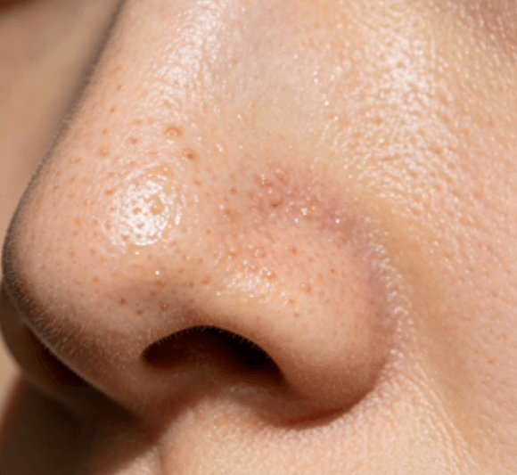 油性肤质常见问题及护肤解答插图