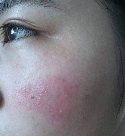 屏障受损:真实案例拆解与科学修护指南 屏障受损:真实案例拆解与科学修护指南