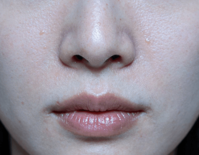 毛孔粗大该如何改善