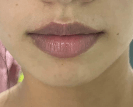 唇周暗沉、嘴角发黑，核心成分精准改善不踩雷