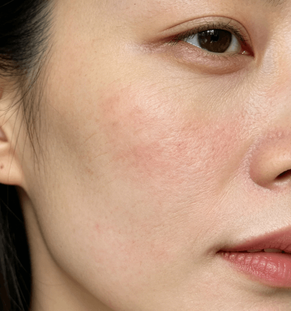 敏感肌屏障受损分级解析：精准判断，科学修护不盲目插图