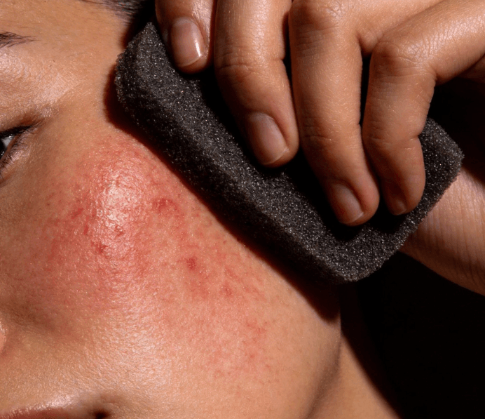 混油敏皮：常见护肤误区与科学养护方案