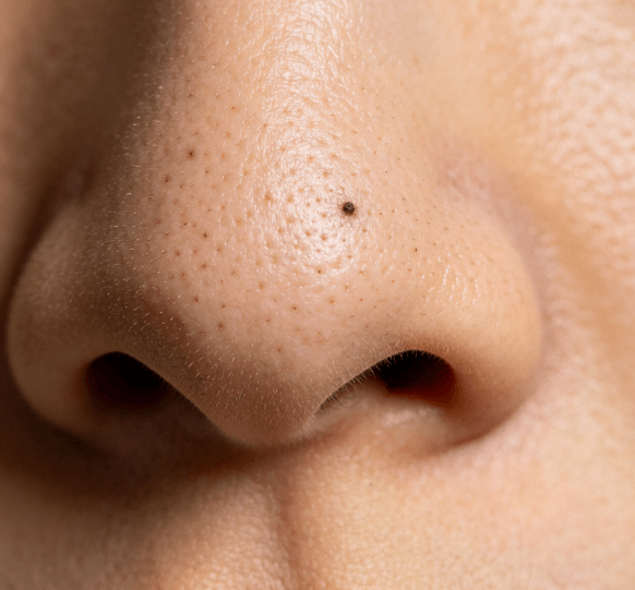 黑头成因深度解析：不止是清洁不到位，这些隐形诱因更关键插图