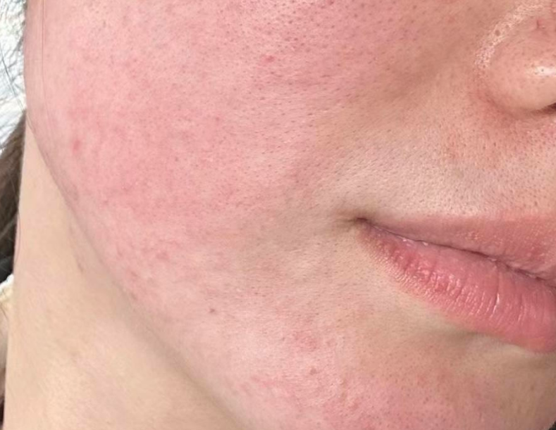 春夏交替，皮肤易敏感、长痘？做好这几点平稳过渡插图