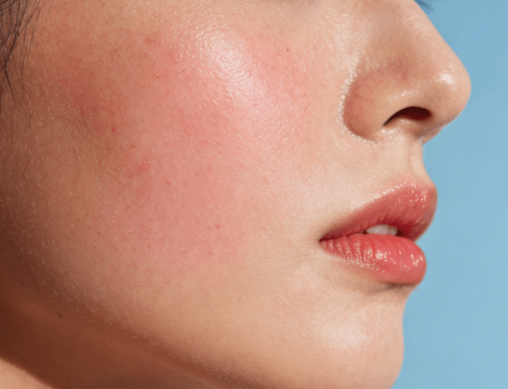 敏感肌泛红,这些成分用错会加重,必看!插图 敏感肌泛红,这些成分用错会加重,必看!插图