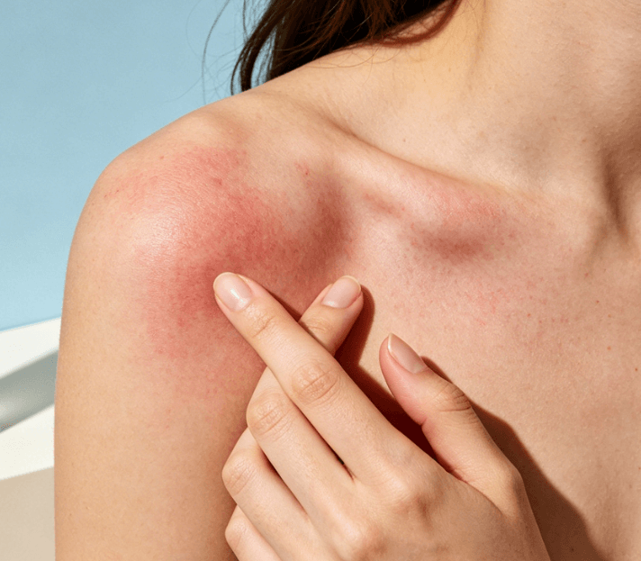 夏季紫外线伤肤原理及全维度防护攻略插图